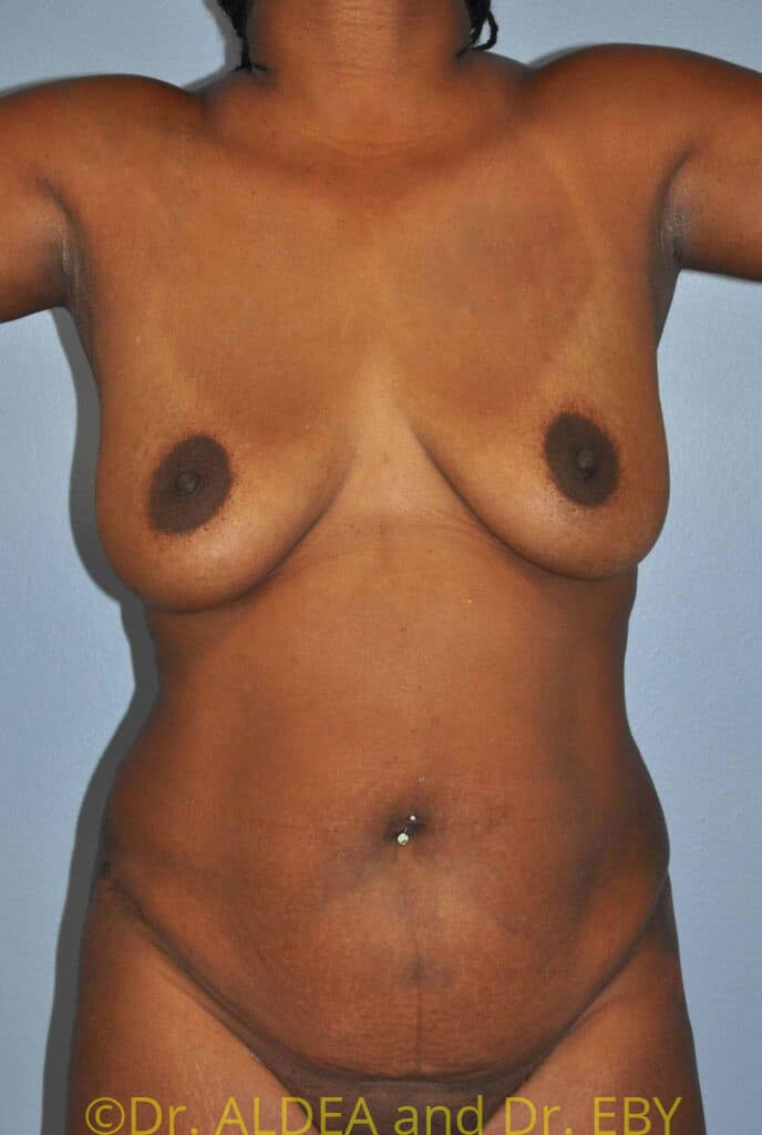 Before Image: Tummy Tuck #334 - front