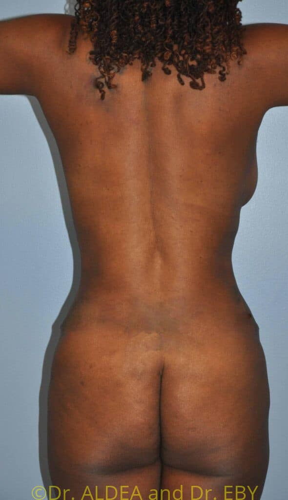 After Image: Tummy Tuck #334 - back