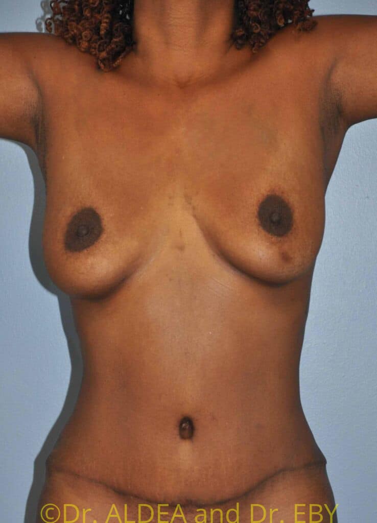 After Image: Tummy Tuck #334 - front