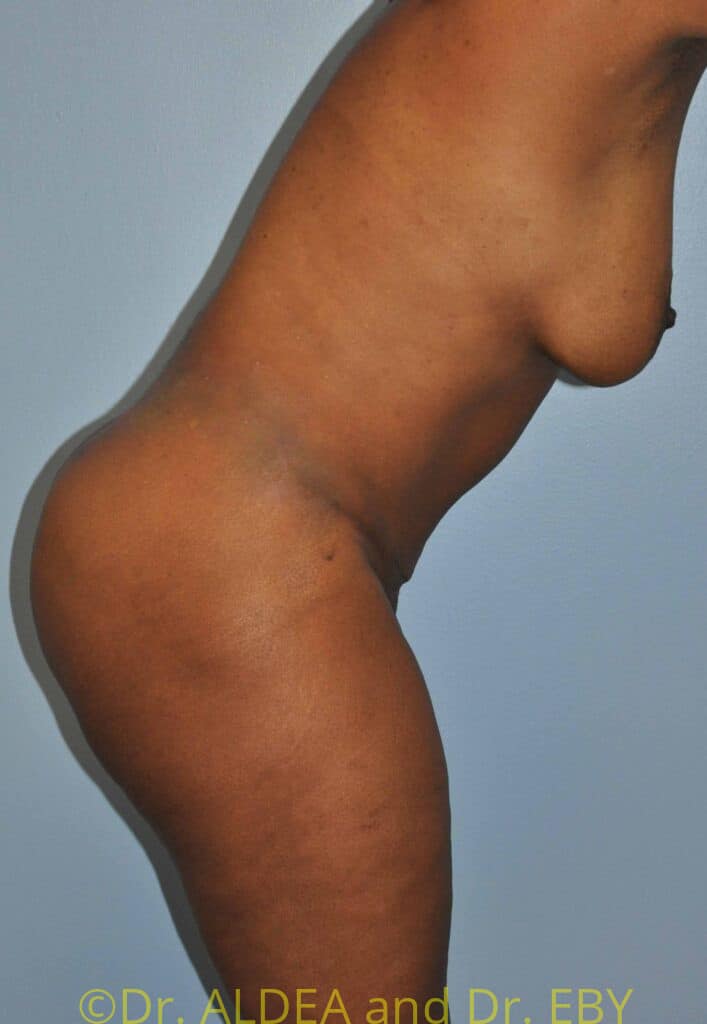 After Image: Tummy Tuck #334 - other