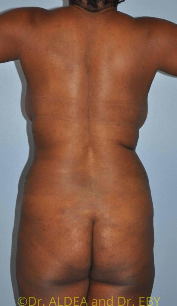 Before Image: Tummy Tuck #334 - back