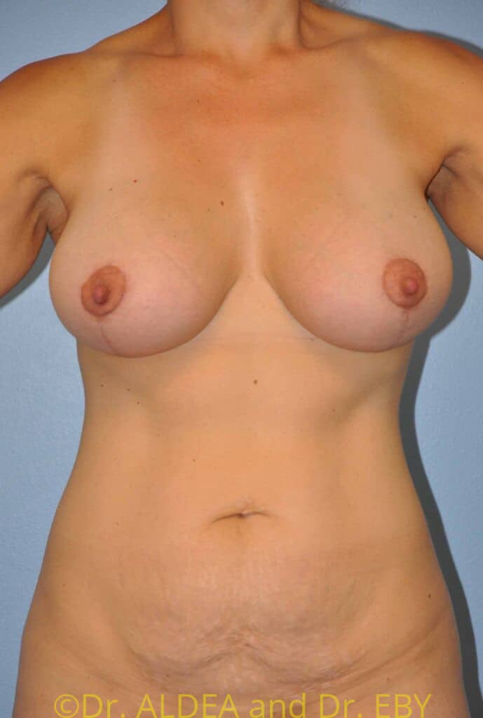 After Image: Breast Augmentation w/ Lift #213 - front
