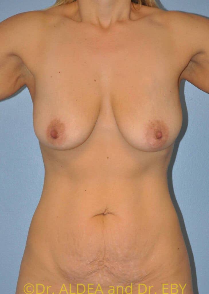 Before Image: Breast Augmentation w/ Lift #213 - front