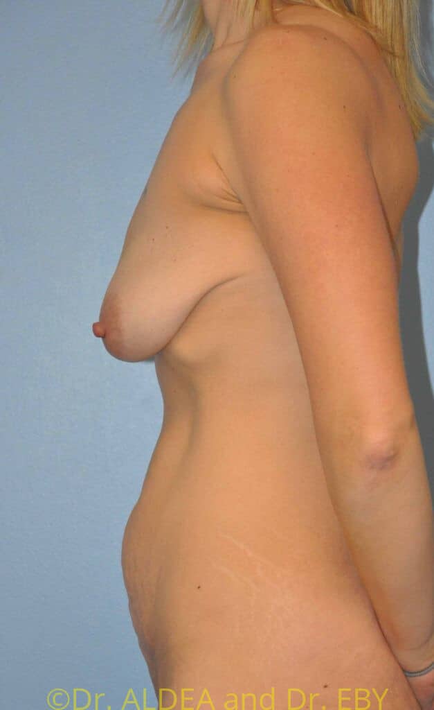 Before Image: Breast Augmentation w/ Lift #213 - left-side