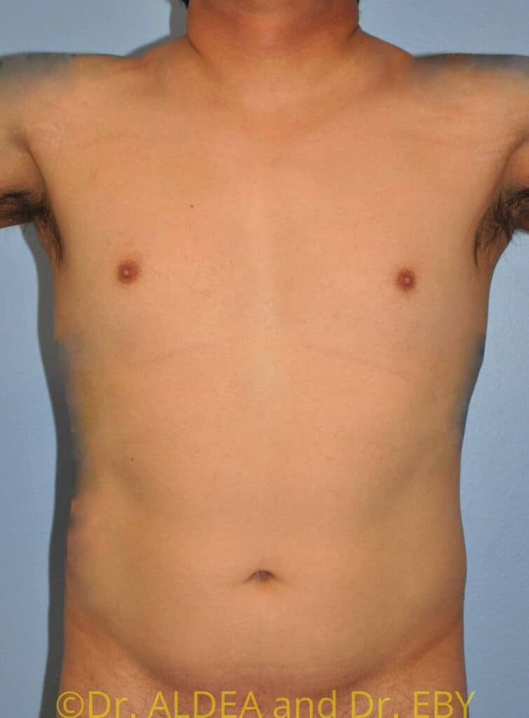 Before Image: Liposuction #502 - front