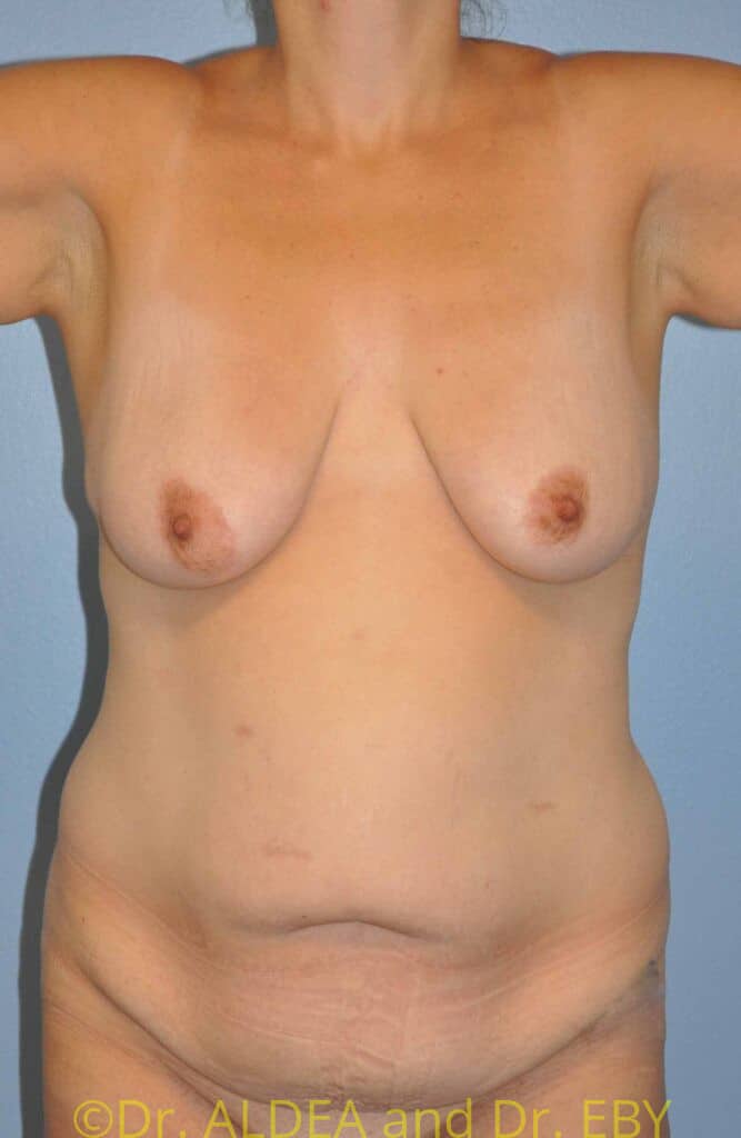 Before Image: Mommy Makeover #765 - front