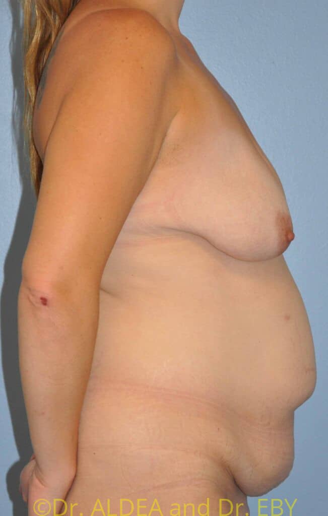 Before Image: Mommy Makeover #765 - right-side