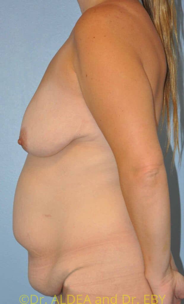 Before Image: Mommy Makeover #765 - left-side