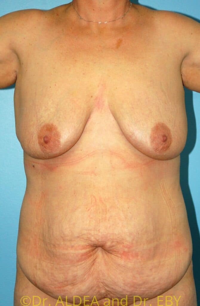 Before Image: Tummy Tuck #931 - front