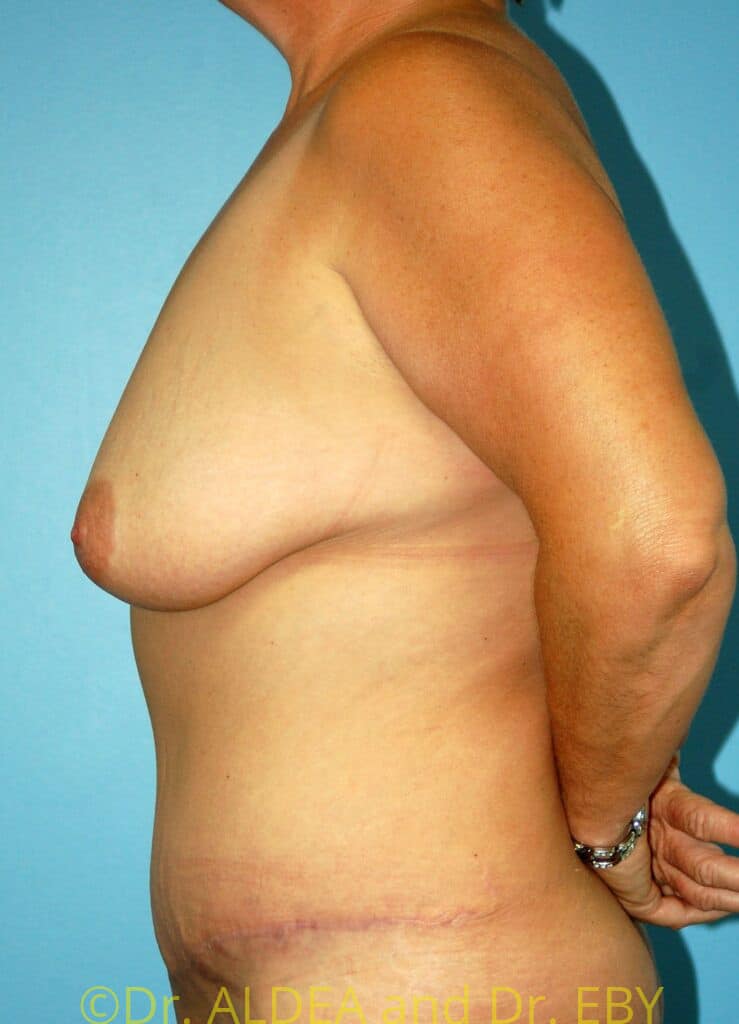After Image: Tummy Tuck #931 - left-side
