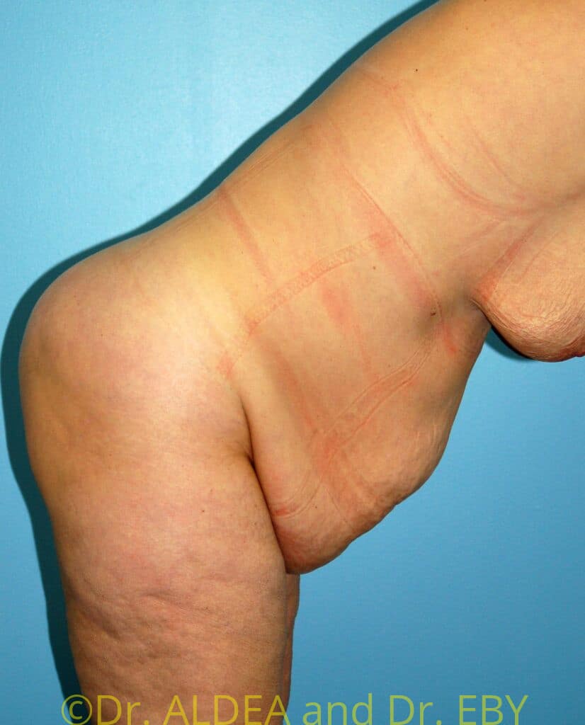 Before Image: Tummy Tuck #931 - other