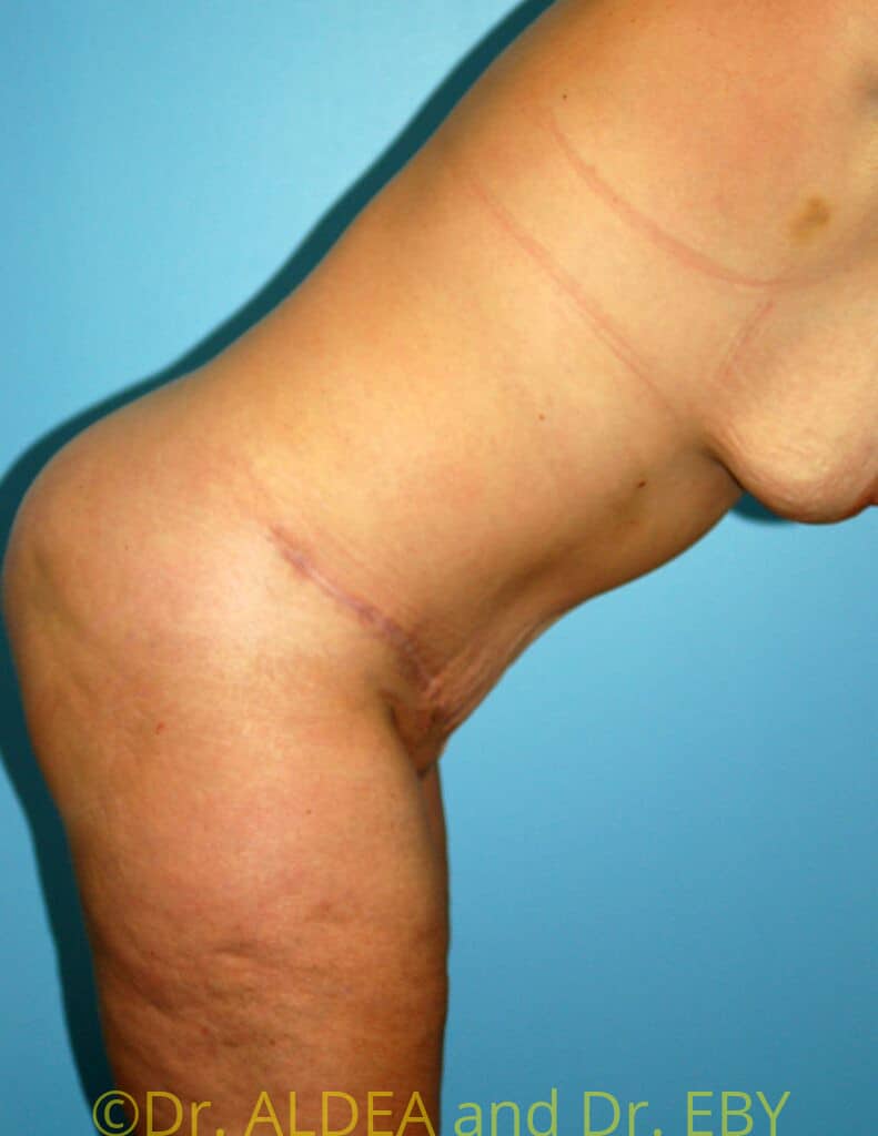 After Image: Tummy Tuck #931 - other
