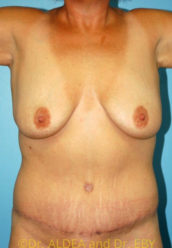 After Image: Tummy Tuck #931 - front