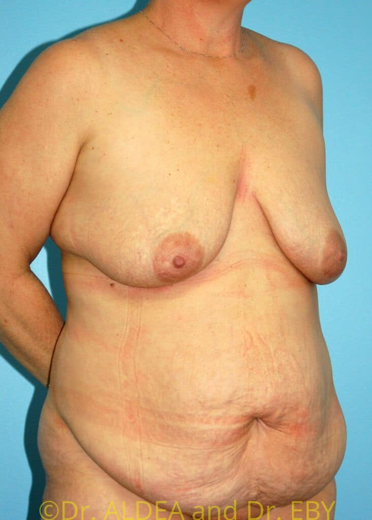 Before Image: Tummy Tuck #931 - right-front-oblique
