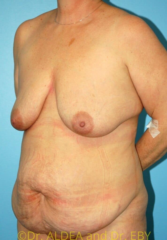 Before Image: Tummy Tuck #931 - left-front-oblique