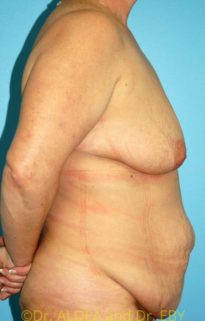 Before Image: Tummy Tuck #931 - right-side