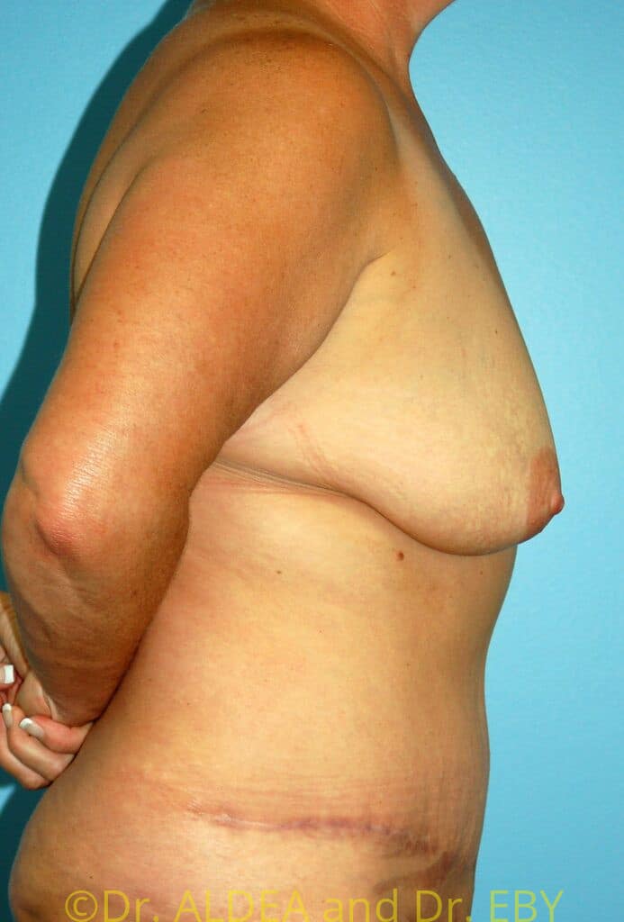 After Image: Tummy Tuck #931 - right-side