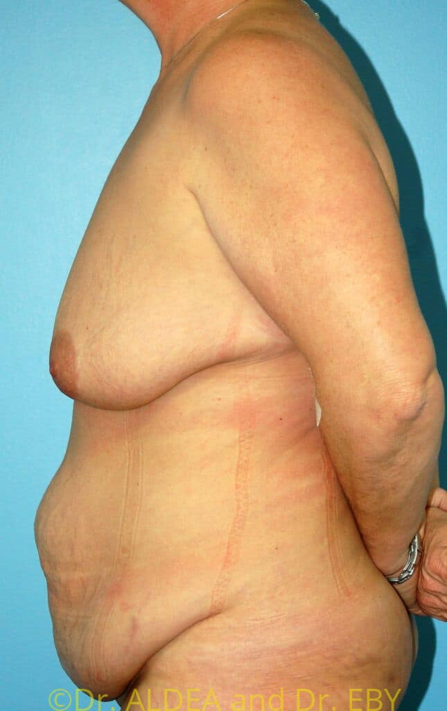 Before Image: Tummy Tuck #931 - left-side
