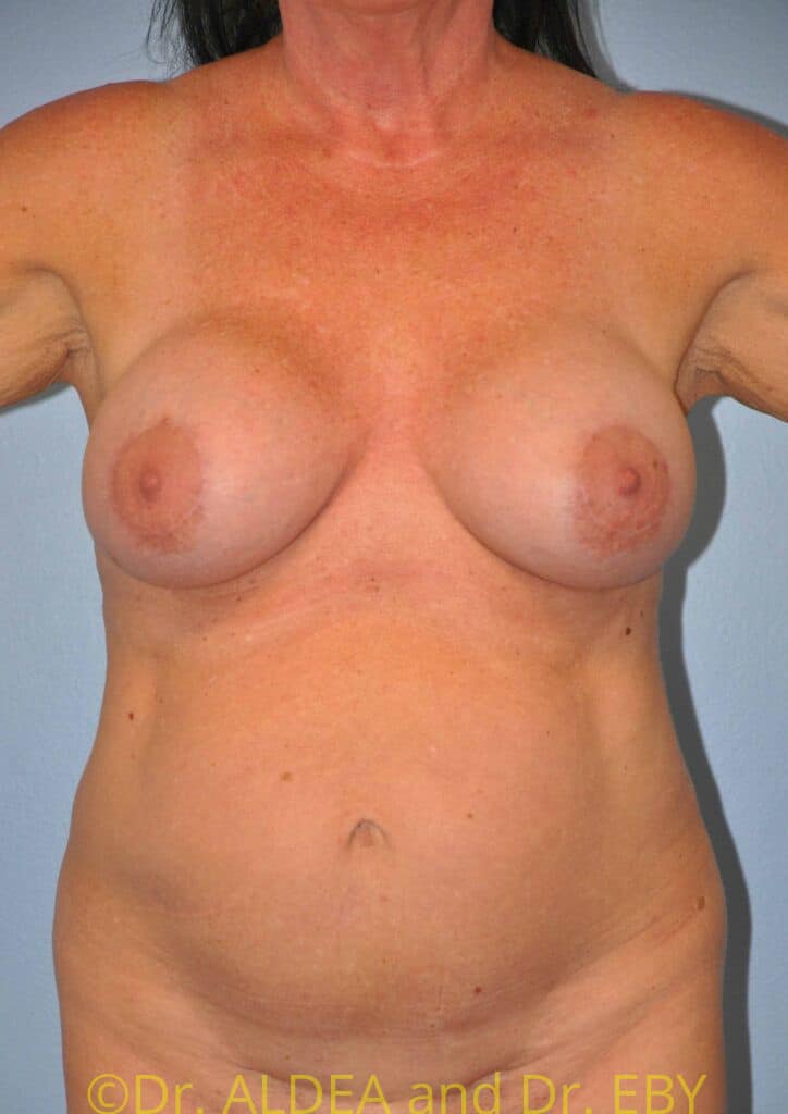 After Image: Breast Augmentation w/ Lift #267 - front