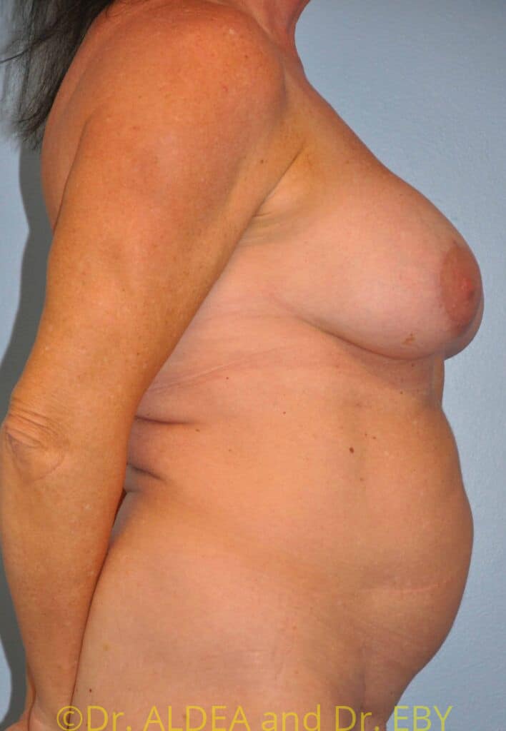 After Image: Breast Augmentation w/ Lift #267 - right-side