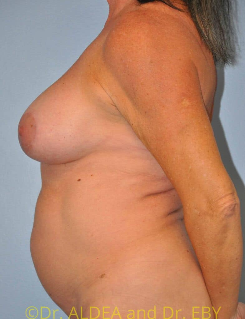 After Image: Breast Augmentation w/ Lift #267 - left-side