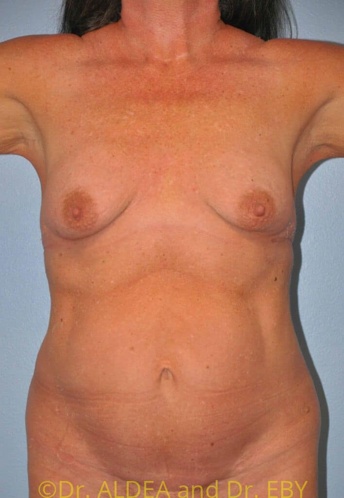 Before Image: Breast Augmentation w/ Lift #267 - front