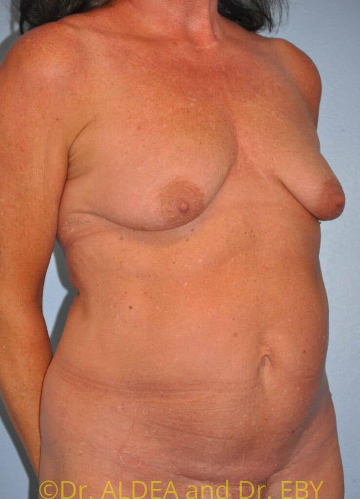 Before Image: Breast Augmentation w/ Lift #267 - right-front-oblique