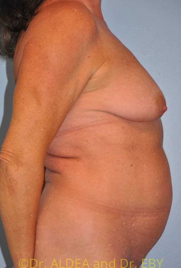 Before Image: Breast Augmentation w/ Lift #267 - right-side