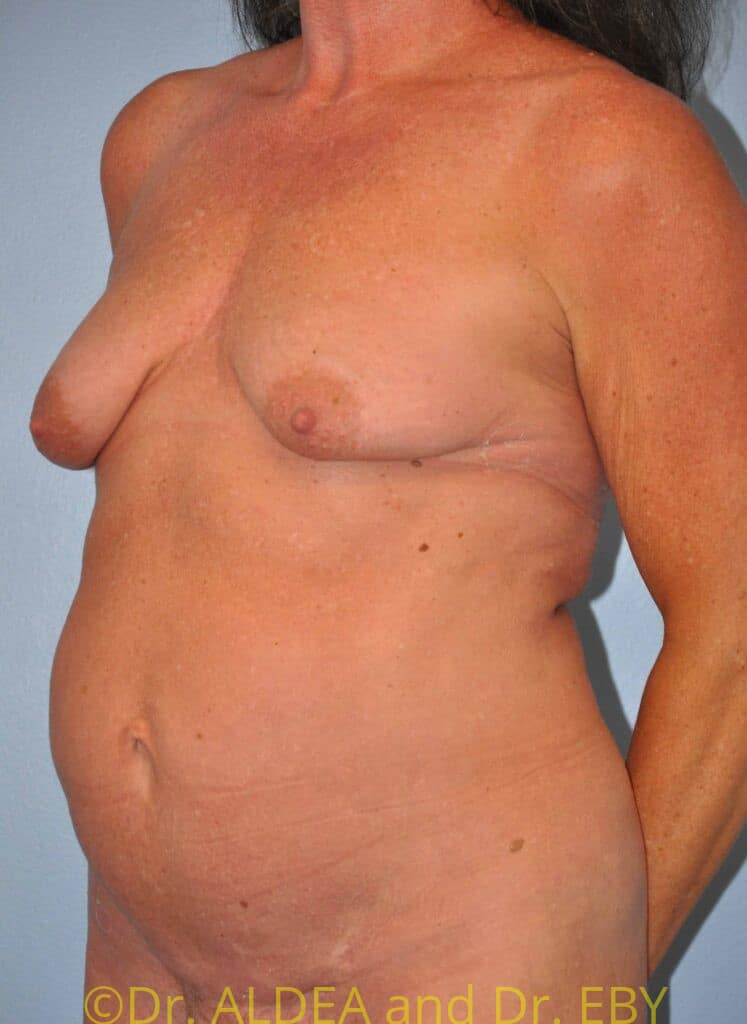 Before Image: Breast Augmentation w/ Lift #267 - left-front-oblique