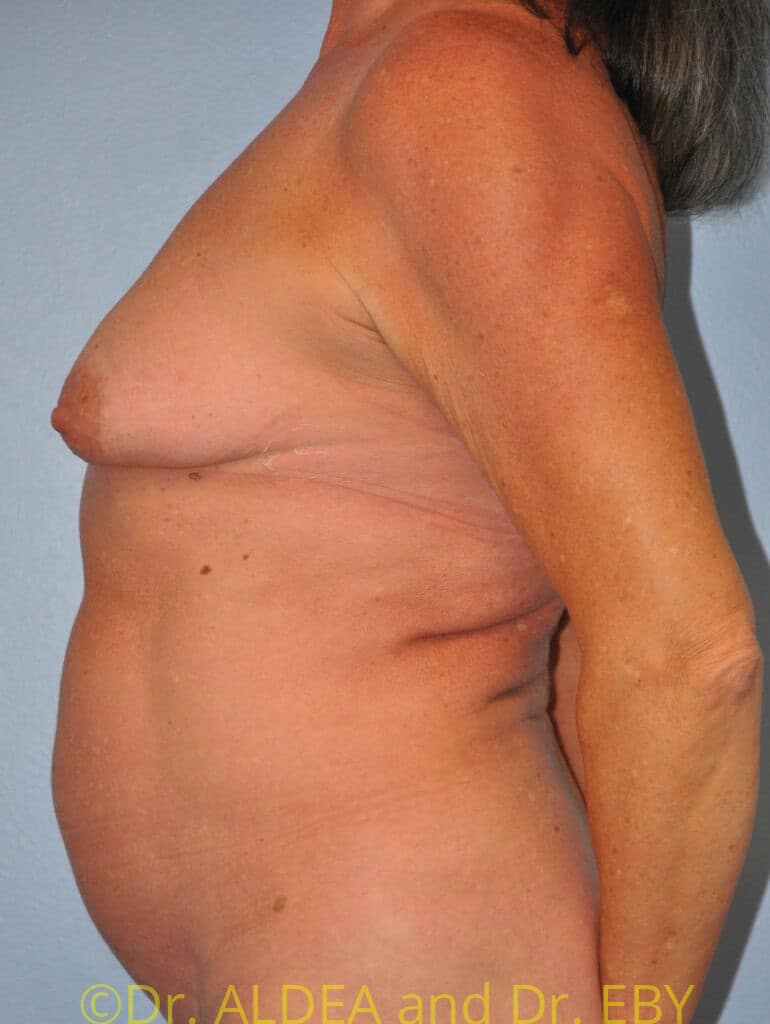 Before Image: Breast Augmentation w/ Lift #267 - left-side