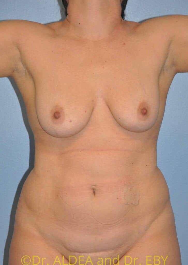 Before Image: Liposuction #842 - front
