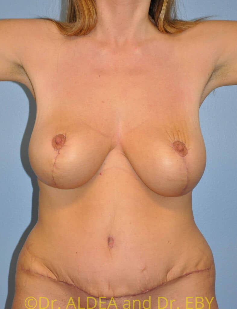 After Image: Mommy Makeover #674 - front