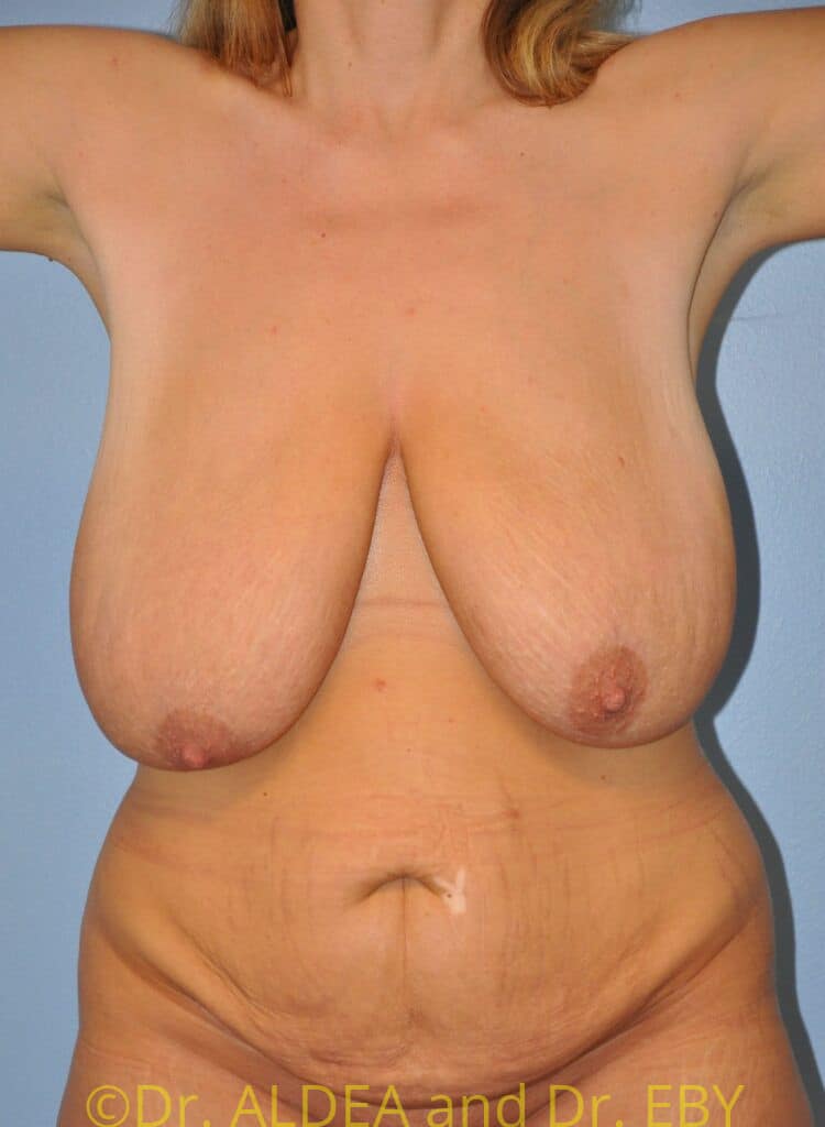 Before Image: Mommy Makeover #674 - front