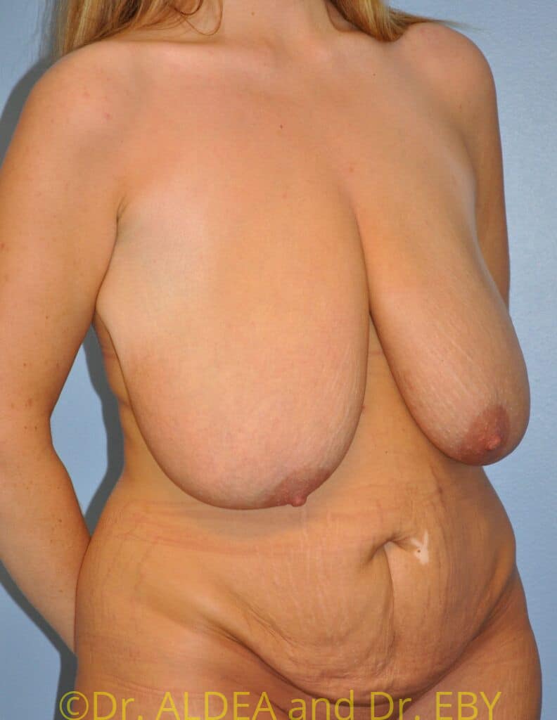 Before Image: Mommy Makeover #661 - right-front-oblique