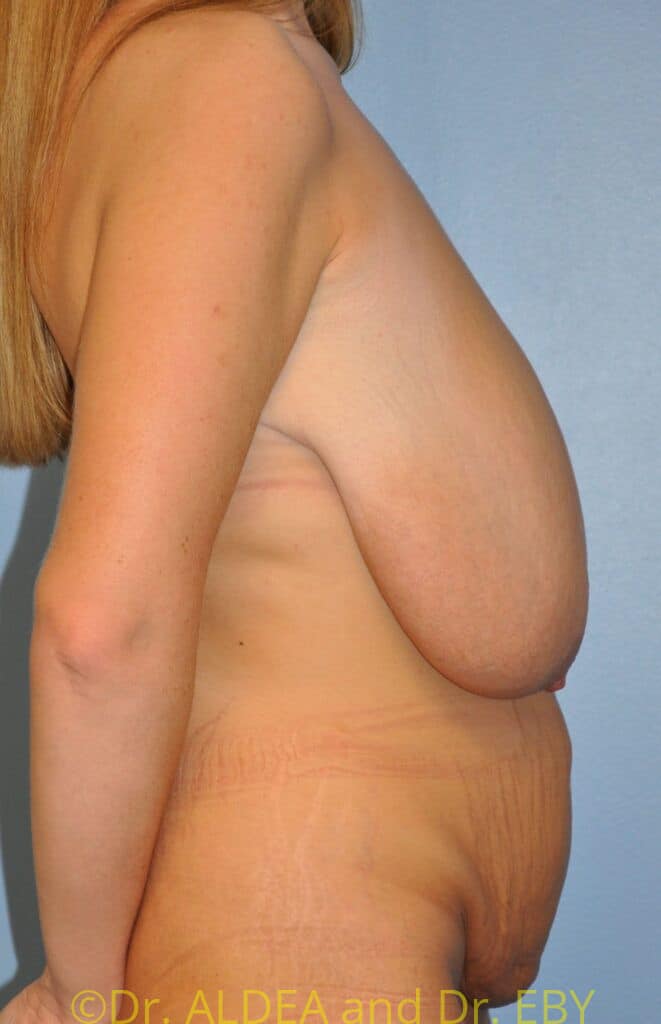 Before Image: Mommy Makeover #674 - right-side