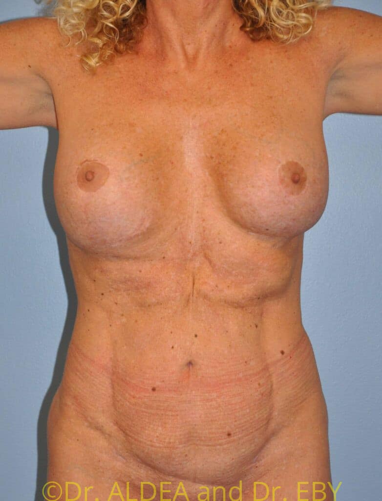 Before Image: Tummy Tuck #181 - front