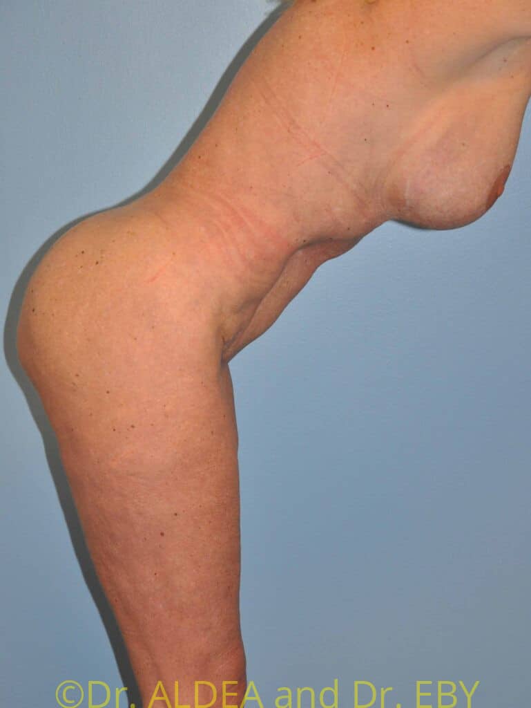 After Image: Tummy Tuck #181 - other