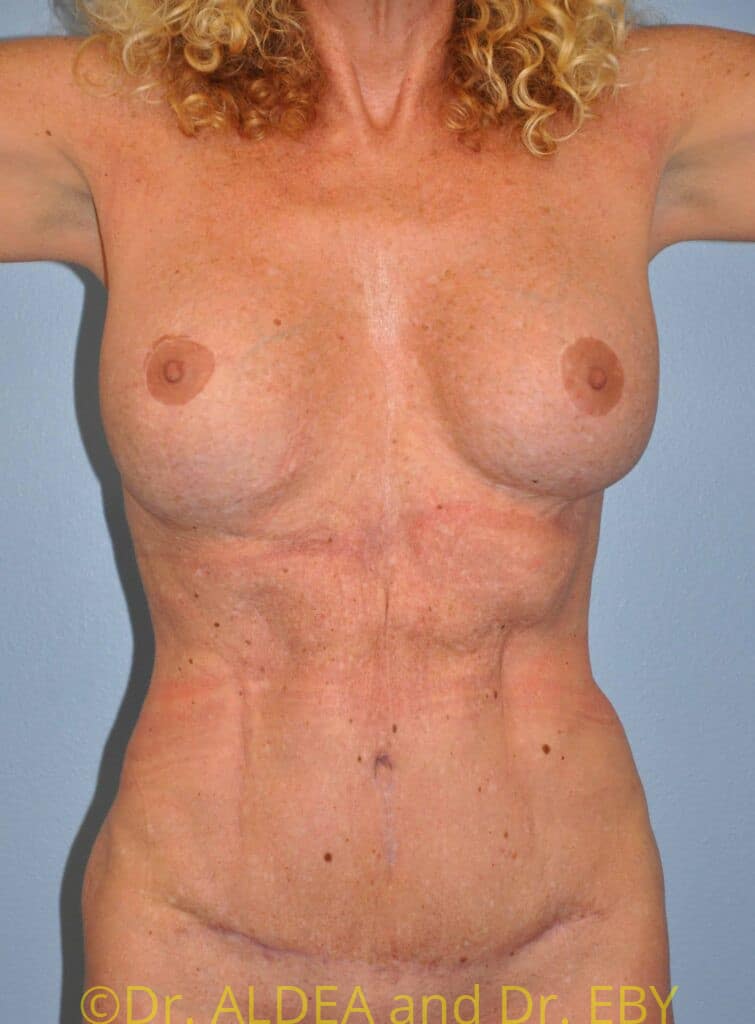 After Image: Tummy Tuck #181 - front