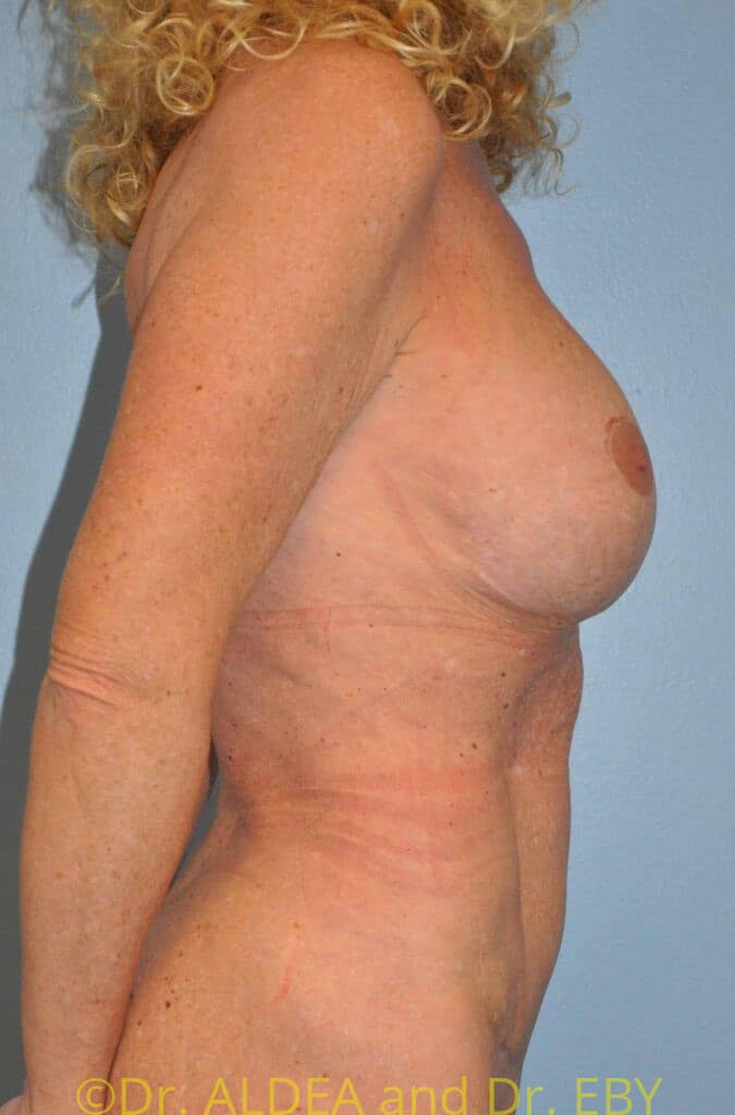After Image: Tummy Tuck #181 - right-side
