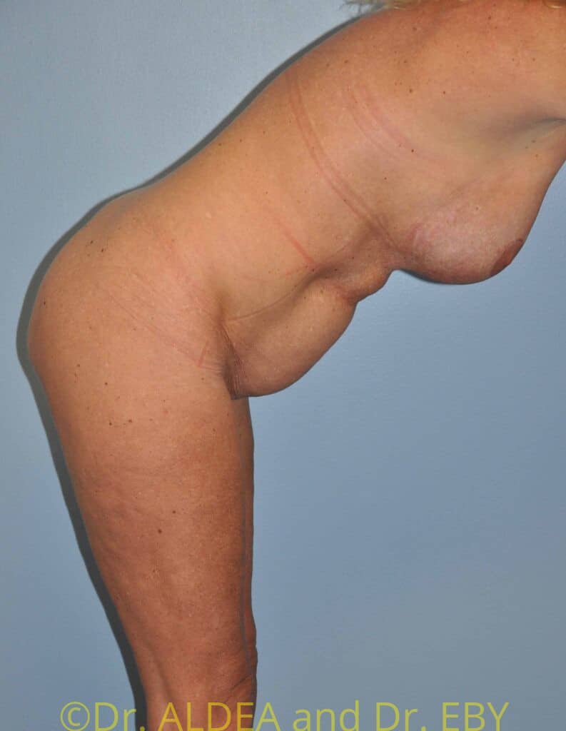 Before Image: Tummy Tuck #181 - other