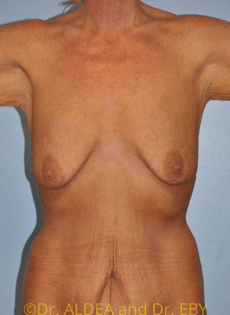 Before Image: Breast Augmentation w/ Lift #371 - front