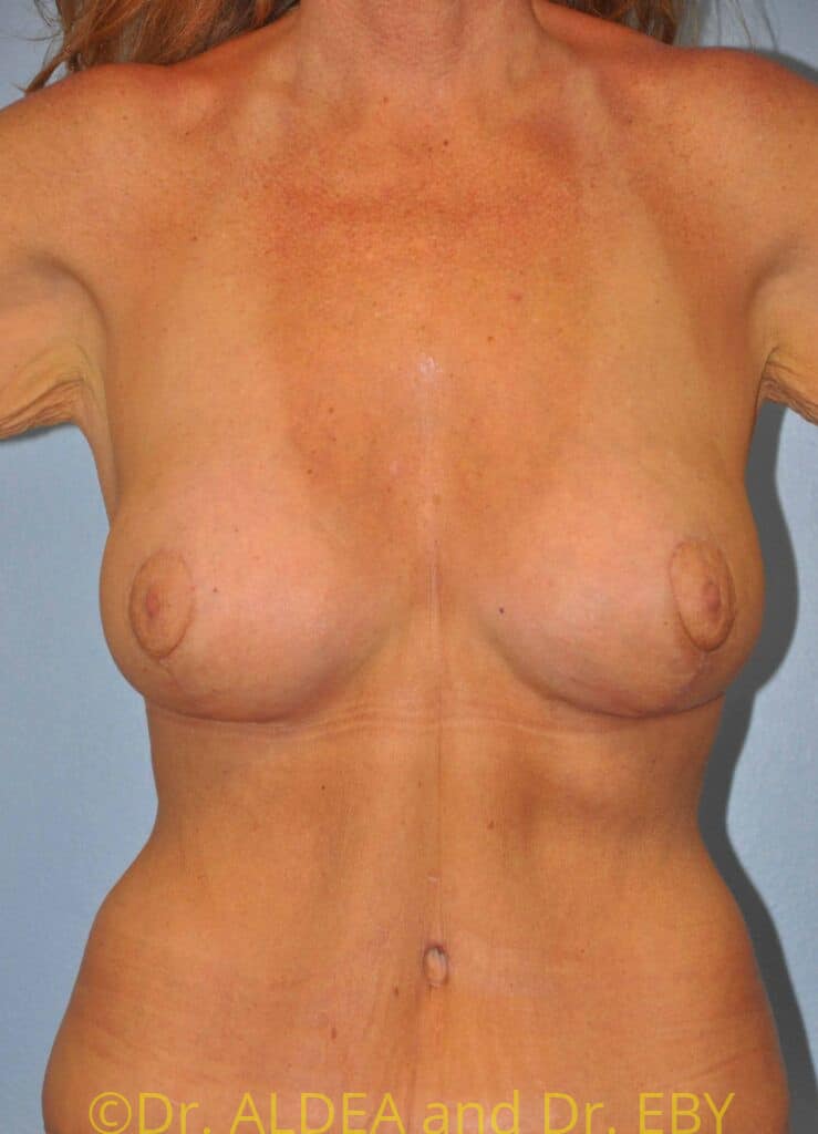 After Image: Breast Augmentation w/ Lift #371 - front