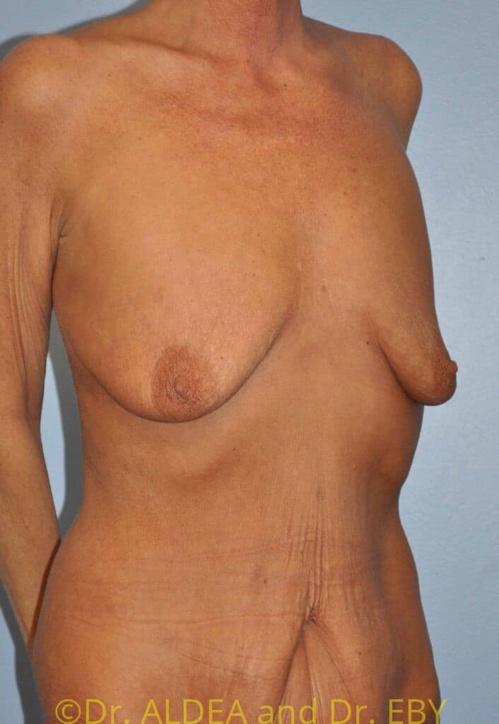 Before Image: Breast Augmentation w/ Lift #371 - right-front-oblique