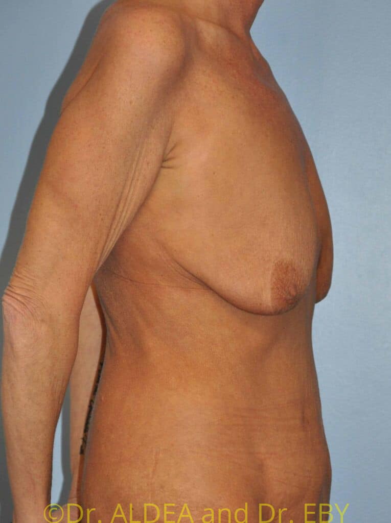Before Image: Breast Augmentation w/ Lift #371 - right-side