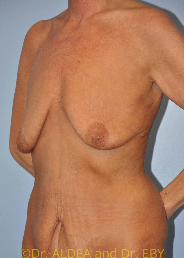 Before Image: Breast Augmentation w/ Lift #371 - left-front-oblique