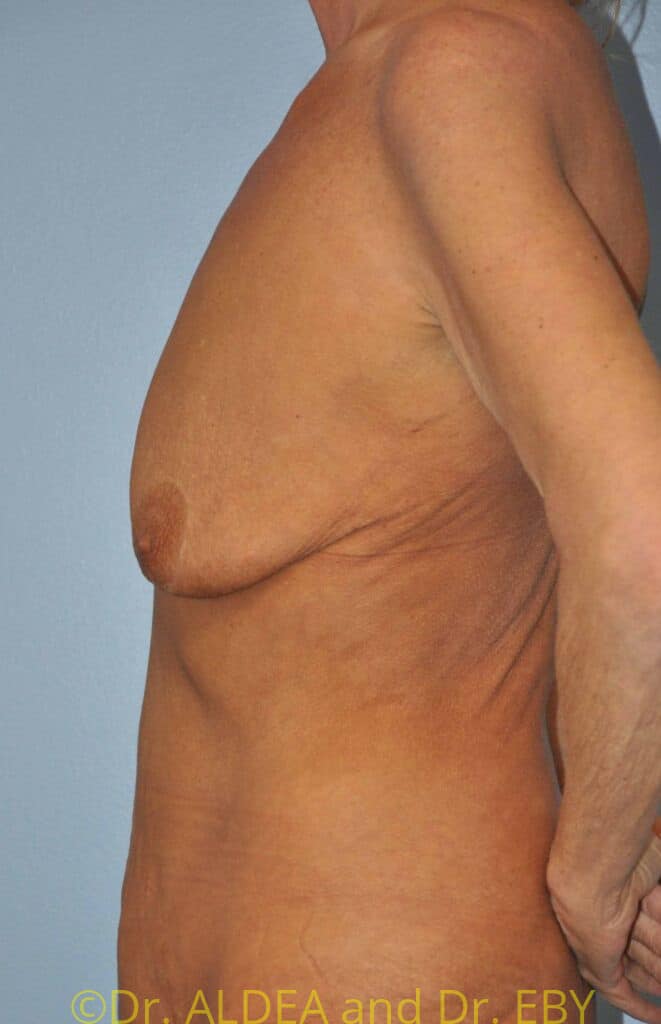 Before Image: Breast Augmentation w/ Lift #371 - left-side
