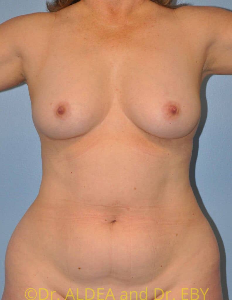 Before Image: Liposuction #774 - front