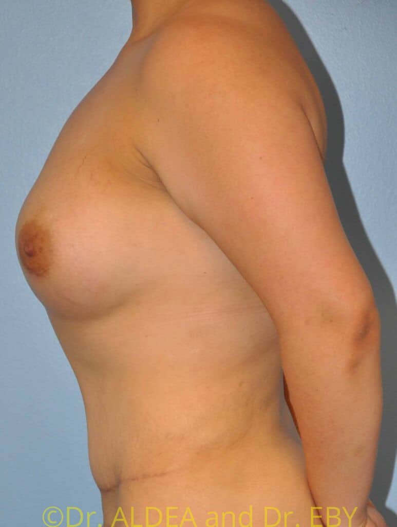 After Image: Mommy Makeover #661 - left-side
