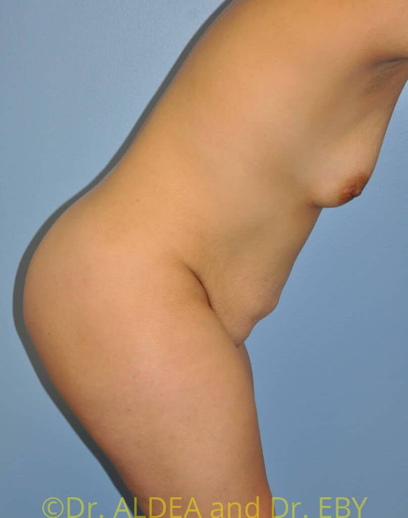 Before Image: Mommy Makeover #661 - other
