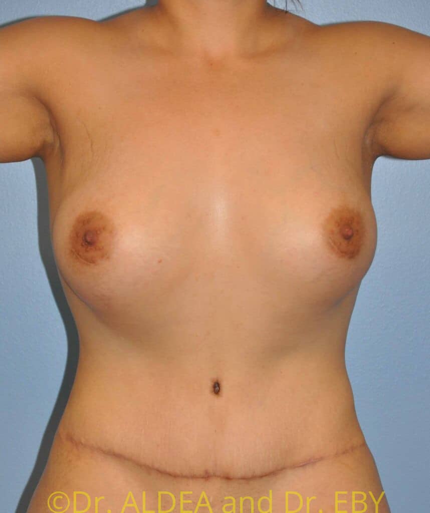 After Image: Mommy Makeover #661 - front
